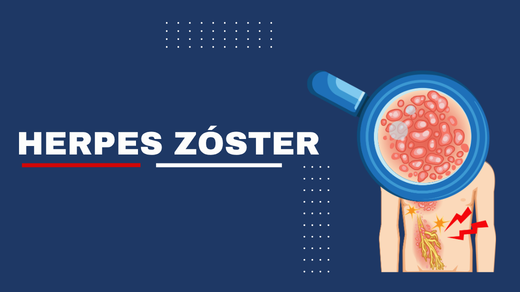 Herpes Zóster