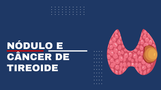 Nódulo e câncer de tireoide