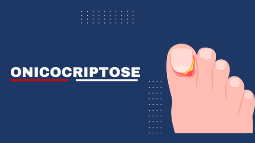 Onicocriptose
